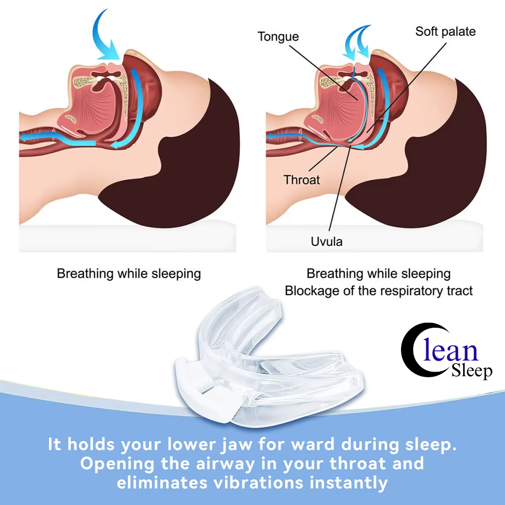 Anti-Snoring Mouth Guard